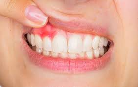 Advanced gum treatment Advanced gum treatment