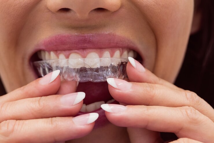 Aligner Aligners