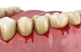 Bleeding gums Bleeding gums