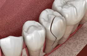 Cracked teeth Cracked teeth
