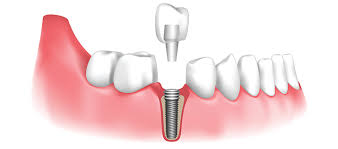 Dental implants Dental implants