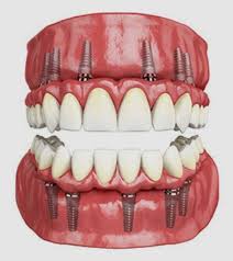 Full mouth rehabilation Full mouth rehabilation