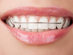 Retainers Retainers