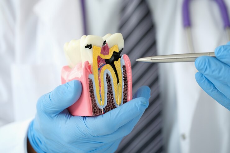 Root canal treatment Root canal treatment