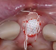 Socket preservation Socket preservation